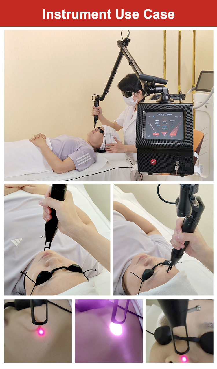 Non invasive Laser Skin Care17